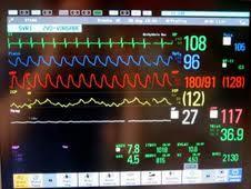 Can t Rely on Vital Signs for Pain Assessment iii.