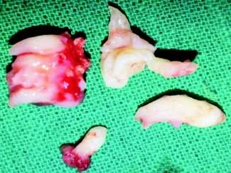 (Figure 7). The surgical cavity was totally smoothened and no complementary treatment was found necessary. Mucoperiosteal flap was closed with interrupted sutures.