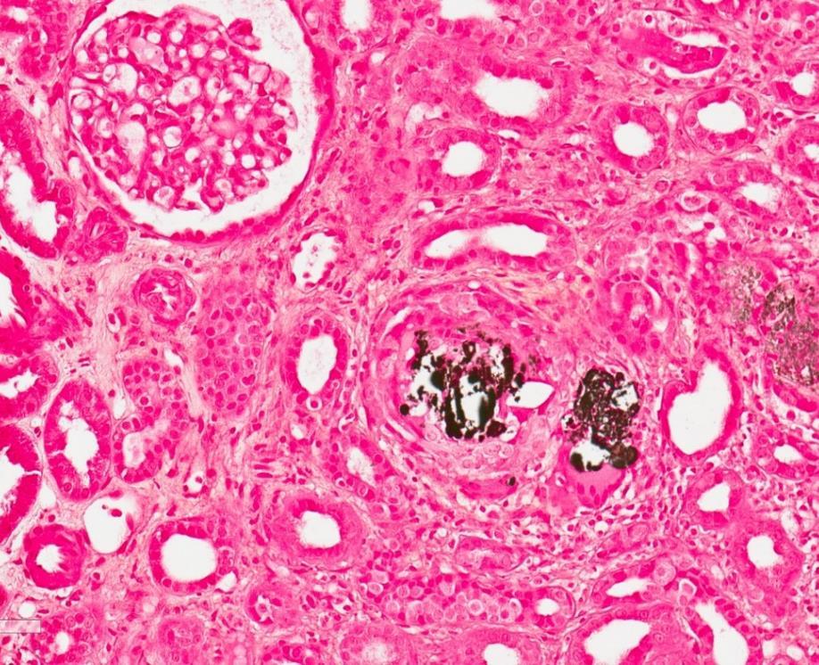 Calcified deposits are positive in Van Kossa histochemical staining, which shows