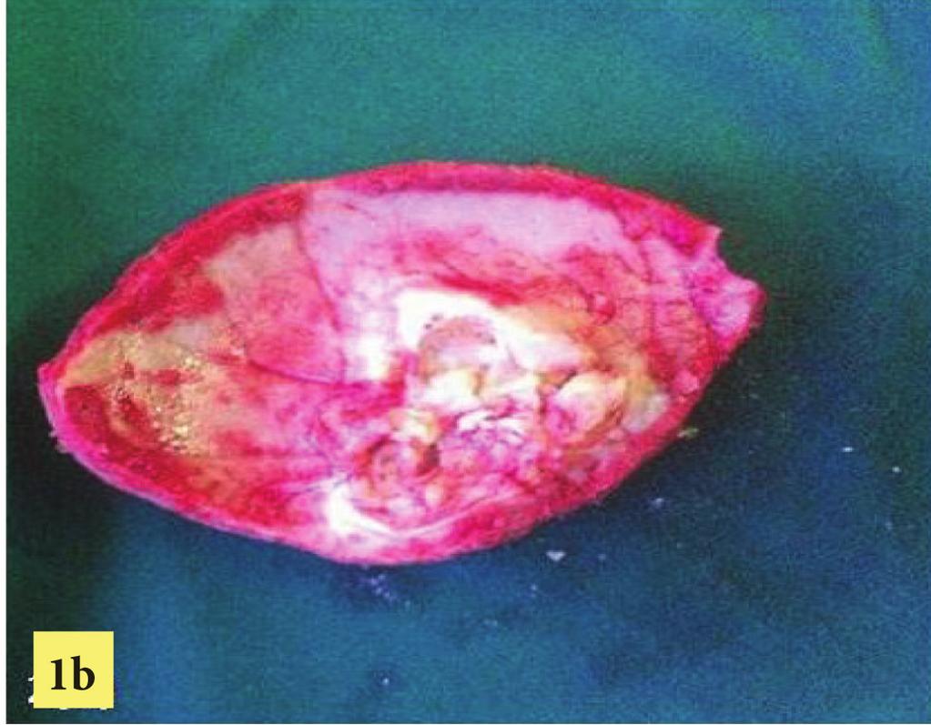 intradiploic expansile cystic lesion with
