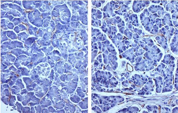 receptor Pancreatic cancer tissue Cells express high