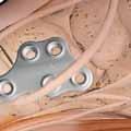 Compression with separate fixation screws may be done prior to plate application, should this be required, one should take care that these separate fixation scews do not hinder late