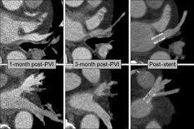 Post-Ablation: pulmonary vein