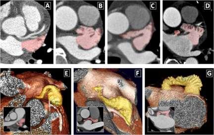Scope of the problem CT in Atrial Fibrillation - before and after pulmonary vein ablation - Assessment of LAA before