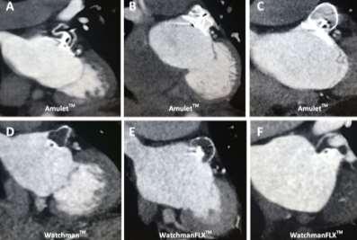 Follow up after percutaneous LAA closure Scope of the problem CT in Atrial Fibrillation CT and