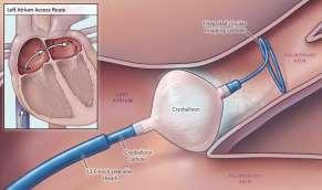 Pre-ablation Role of