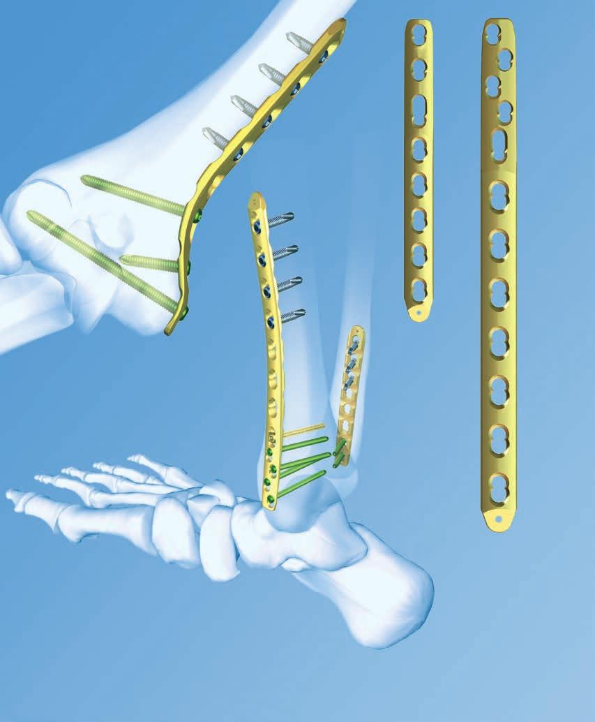 LCP Metaphyseal Plates. For extra-articular fractures.