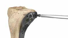 It is advisable to tap hard (dense) cortical bone before inserting a locking screw. Use the 4.0mm locking tap (Ref 702772).