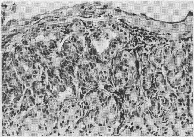 The adenoma presents a structure which is almost identical with that of the main lacrimal gland, being composed of tubuli and acini, covered by cubical or prismatic