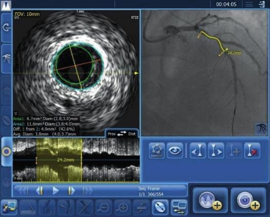 Physiology outperforms angiography in predicting