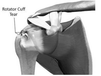 Physical exam maneuvers that increase likelihood of full thickness rotator cuff tear 1.