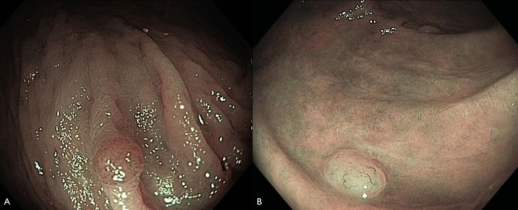 Figure 1 Endoscopic image with narrow band imaging of diminutive colorectal polyps. (A) Adenoma and (B) non-neoplastic polyp.
