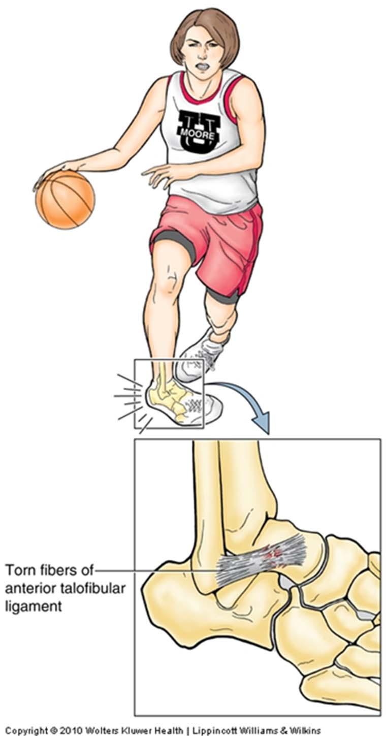 Ankle Joint: Injuries Ankle injury > other major joint in the body Ankle sprain
