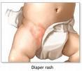 2- Diaper or Napkin rash Common in: Babies who their mothers do not change