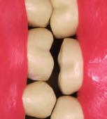 Veneers, PJCS & All Ceramic Crowns Using Supra-Gingival Dentistry Principles motivate patients accept veneer services prepare veneers in 5 minutes per oth (with some exceptions) insure patient