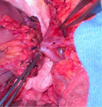 (c) Intra-operative picture of a borderline resectable tumour involving the PV. This tumour required the resection of the PV.