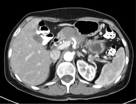 (e) Locally advanced un-resectable pancreatic cancer encasing the SMA depicted by a bold arrow following criteria: (i) tumour-associated deformity of the SMV and PV; (ii) abutment of the
