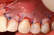 retained on implants Checking the