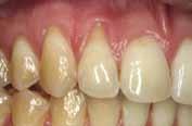 implant margin is visible due to