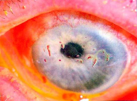 Filamentary Keratitis Keratoconjunctivitis sicca, or dry eye syndrome, is the most common issue with RA patients.