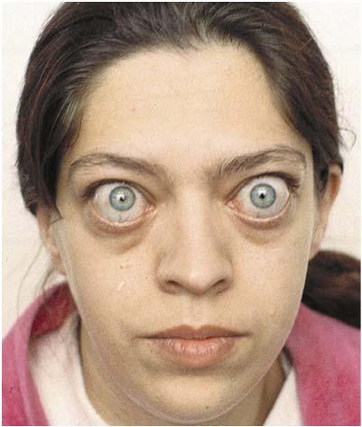 EyeLid Issues Exophthalmos Thyroid (Graves Disease), Structural/Deformity Ectropion, Injury, Burns Lagophthalmous Floppy Eyelid Demodex Mechanical (Surgical