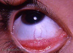 Allergic Causes of Eye Inflammation/Dryness Could be chronic or acute, depending on form of allergic reaction, Seasonal Irritants