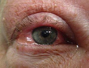 Dry Eye Testing Shirmer Test 50% 10 mm in 5 minuets Phenol Red Thread 20mm in 15 seconds Tear Break up Time Corneal Staining Tear Prism Height Debris in Tear Film Questionaires 80% 72% Tear Lab