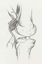 anterior knee pain Patellar mobility is critical