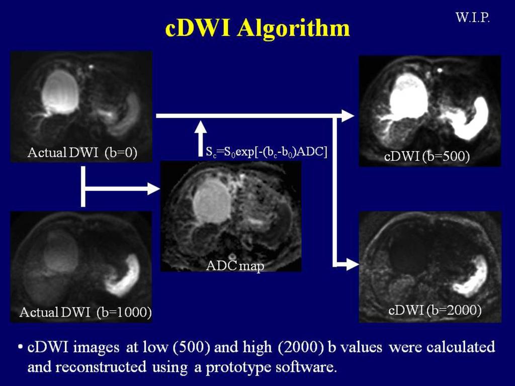 Image quality for cdwis (b=500) were assessed using a 5-point scale and compared to that of actual DWI (b=1000).