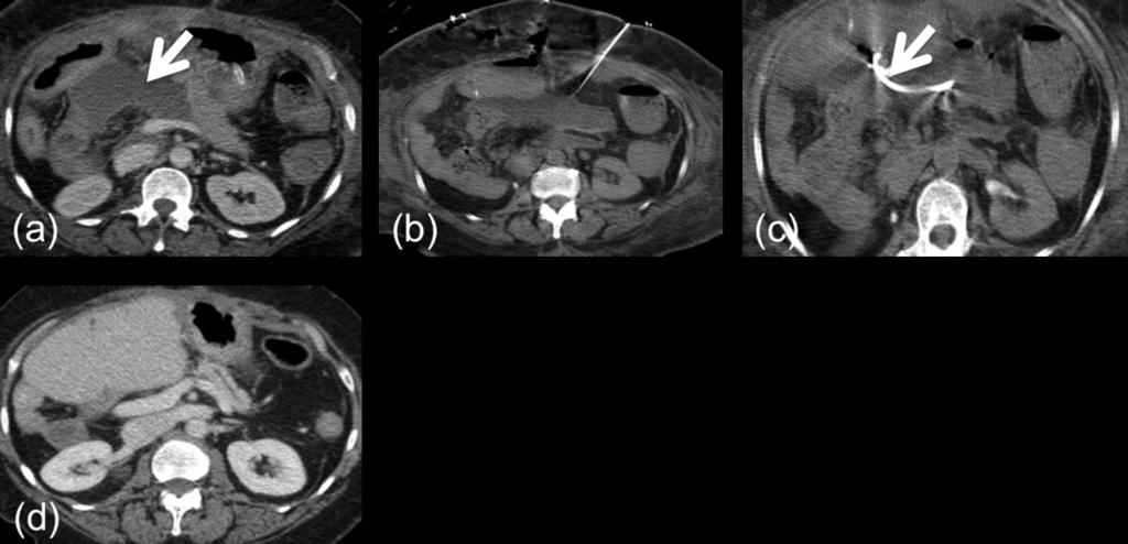 (c) A pigtail drain was inserted followed by complete resolution of the hepatic abscesses on follow up imaging. Fig.