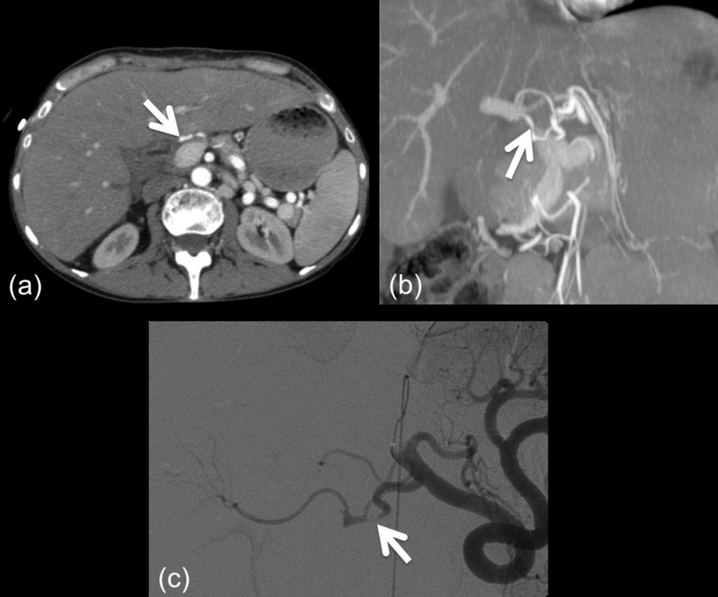 which confirmed pancreatic leak. (c) Pigtail drain within the collection. (d) Complete resolution of collection on follow up CT. Fig. 10: Patient post liver transplantation.