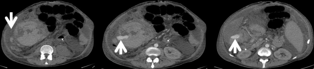 Axial portal venous phase CT shows multiple areas of low attenuation within the liver in