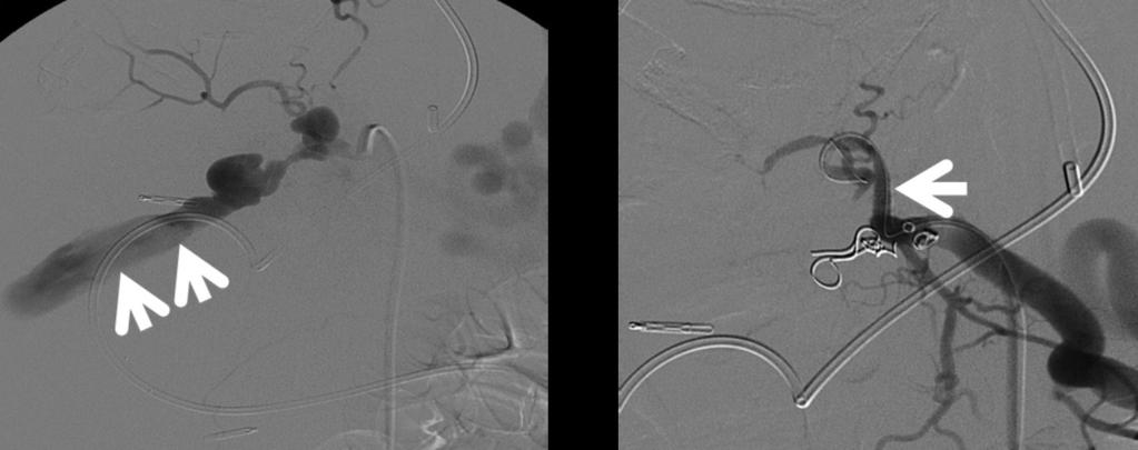 12: Hepatic artery bleed following liver transplantation on CT.