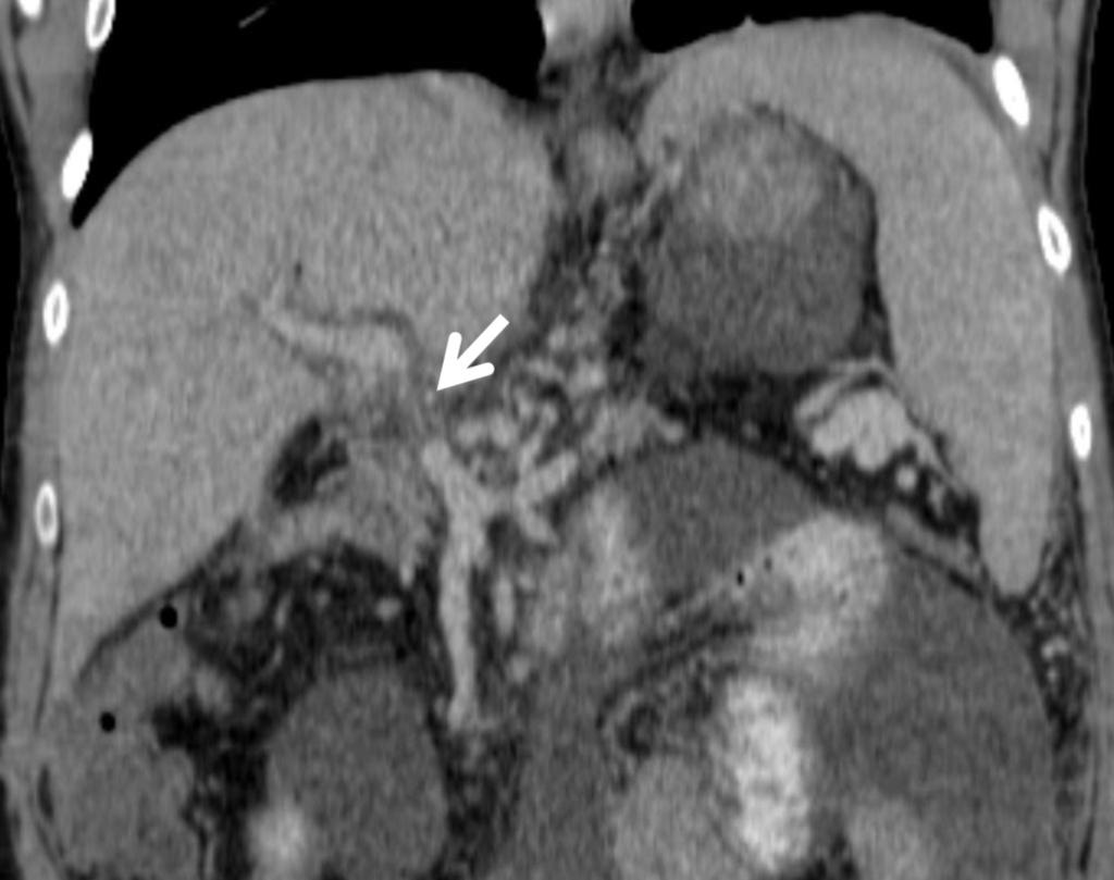 Fig. 13: Same patient as in Figure 12 post liver transplantation. (a) Angiogram demonstrates active contrast extravasation from the hepatic artery in keeping with active bleeding.