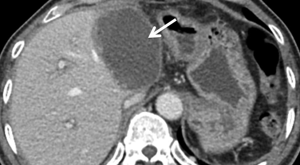 Cholangiogram indicates long stricture in the main right intrahepatic duct (b) which was dilated with a balloon (c). Fig.