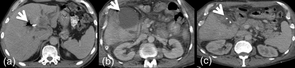 Fig. 5: Contrast enhanced axial CT post extended left hepatectomy illustrating a gas containing collection adjacent to the liver