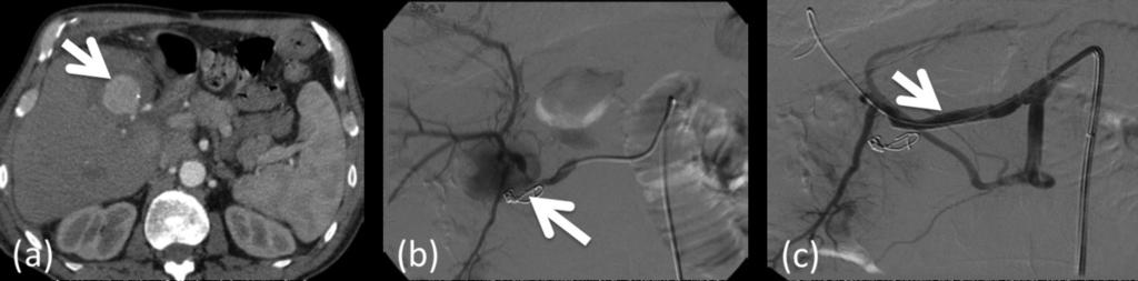 Angiography confirmed presence of hepatic artery pseudoaneurysm (b). Fig.