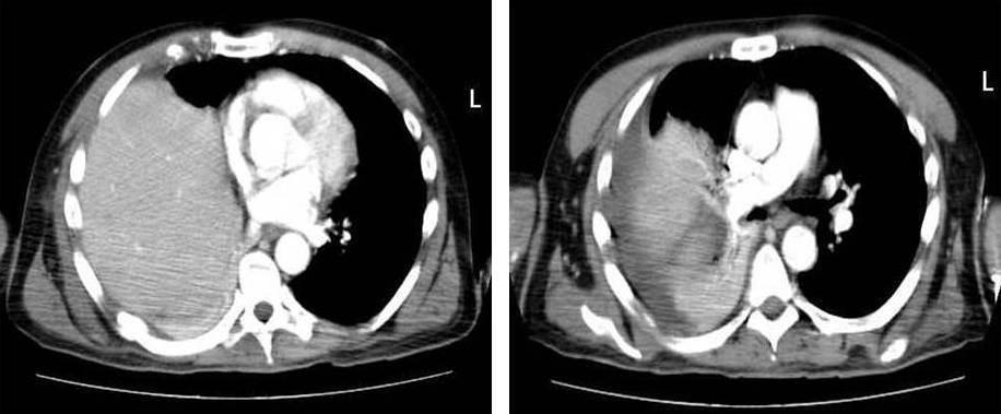 FIGURE 1. CT of the thorax highlights the obliteration of the pleural cavity by the liver and pulmonary parenchyma compression. (I.S.) along the midaxillary line.