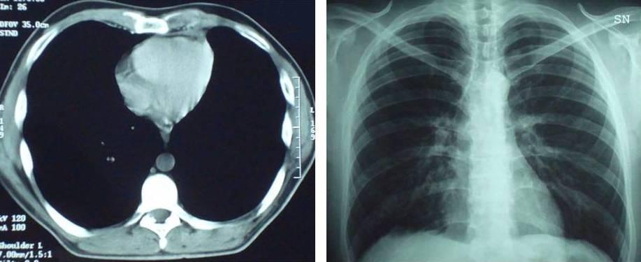 FIGURE 4. CT of the thorax and chest X-ray at 12 months showed maintenance of a normal anatomical position of the lung as well as the diaphragmatic line.