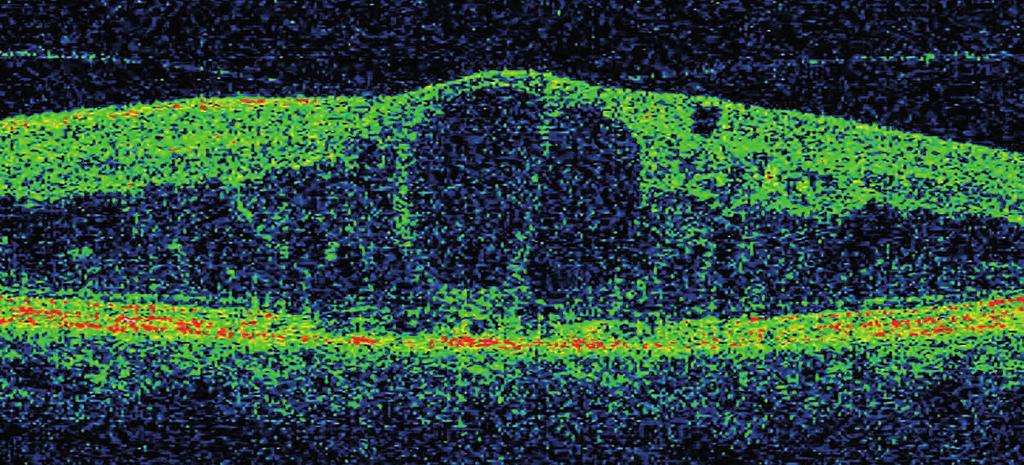 Fig 2. OCT scan of the macular. The normal foveal architecture is not discernable. There is prominent oedema and the retina in cross-section resembles the appearance of a sponge.