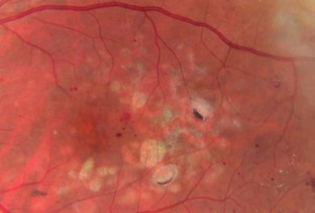 Treating Diabetic Macular Oedema MACULAR LASER Laser treatment for clinically significant macular oedema (CSMO) has been the mainstay form of treatment after the findings by the Early Treatment