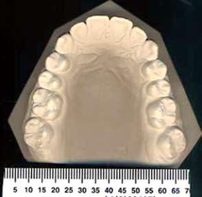 To place the molar correctly, we then measure the distance from the lower incisor (most prominent) to the mesial of the first molars on the occlusograms of the lower and upper casts, respectively.