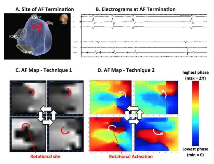 technique 1 (activation/phase mapping, FIRM) vs technique 2 (unipolar electrograms/phase maps of activation) Revealed a source in 12 of 12 (100%) cases