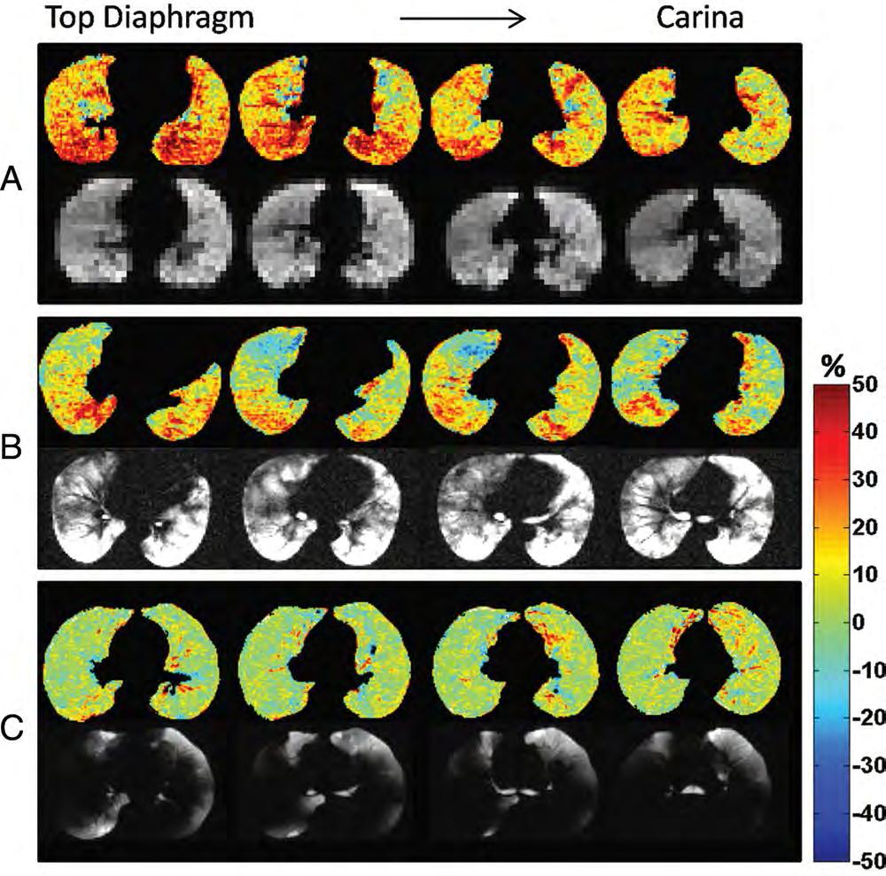 Maps of proton-signal-density difference Proton signal change within the lung between different lung volumes (TLC and registered RV) is a reliable estimate of regional lung function Multi-volume MRI