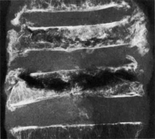 Wedge-shaped vertebral bodies. In this cadaver with osteoporosis, a lateral radiograph of the midthoracic spine reveals vertebral collapse, most extensive along the anterior surface of the spine.
