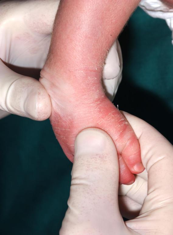 Clubfoot Clubfoot affects 1 in every 1000 births.