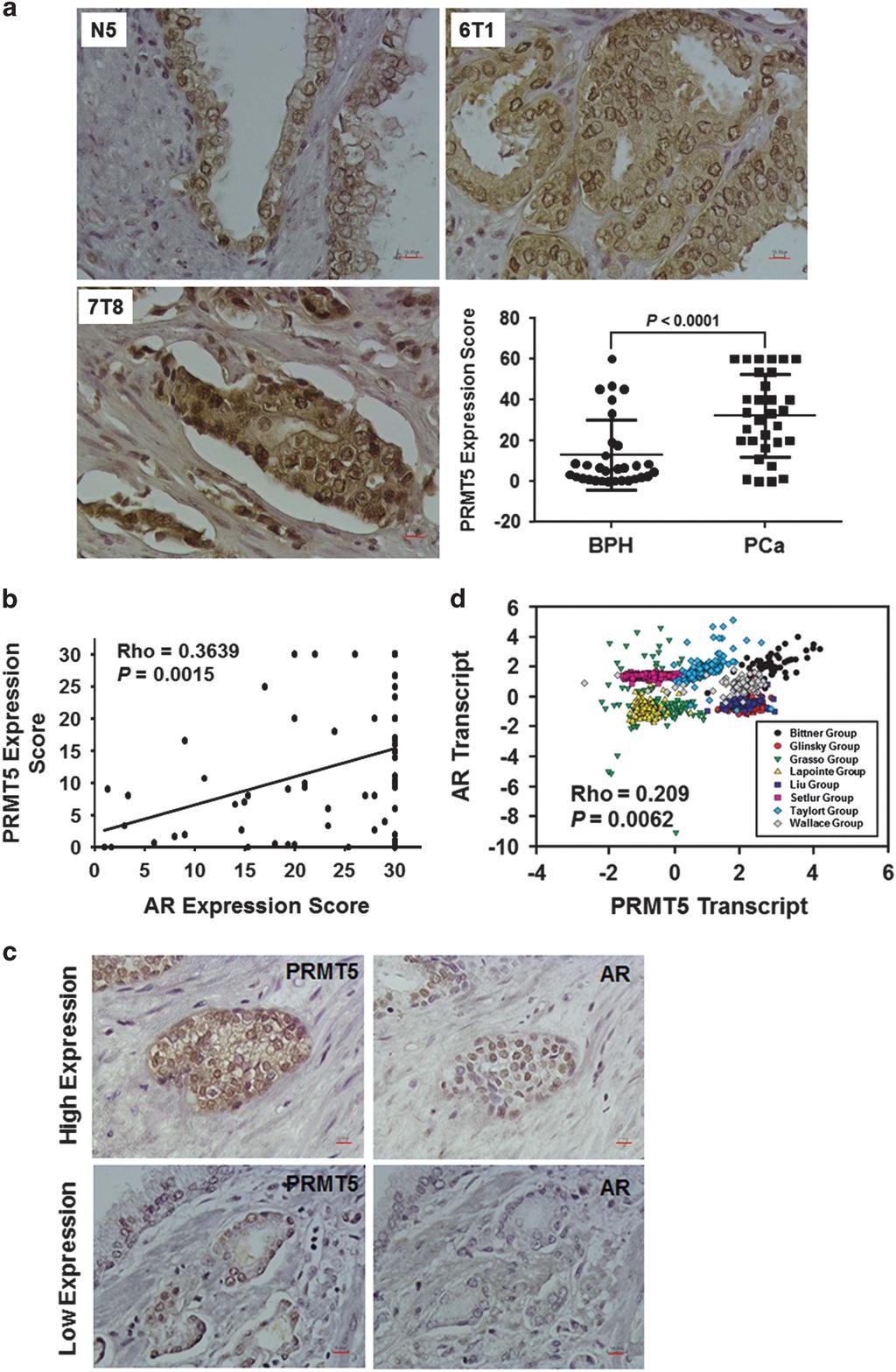 1228 Epigenetic activation of AR transcription by PRMT5 X Deng et al Figure 4. PRMT5 expression correlates positively with AR expression in prostate cancer.