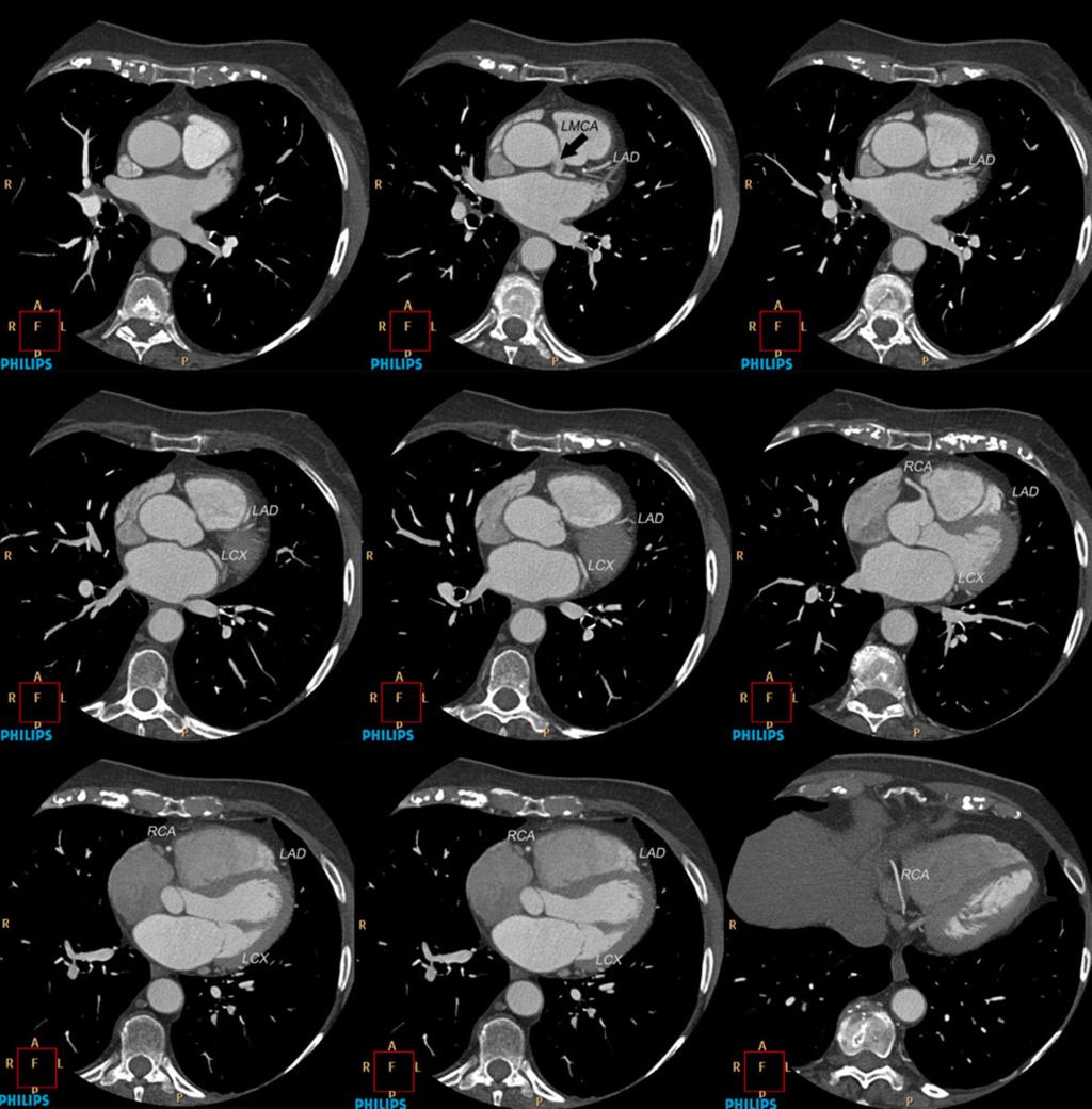Fig. 2: Consecutive axial CT images displaying the