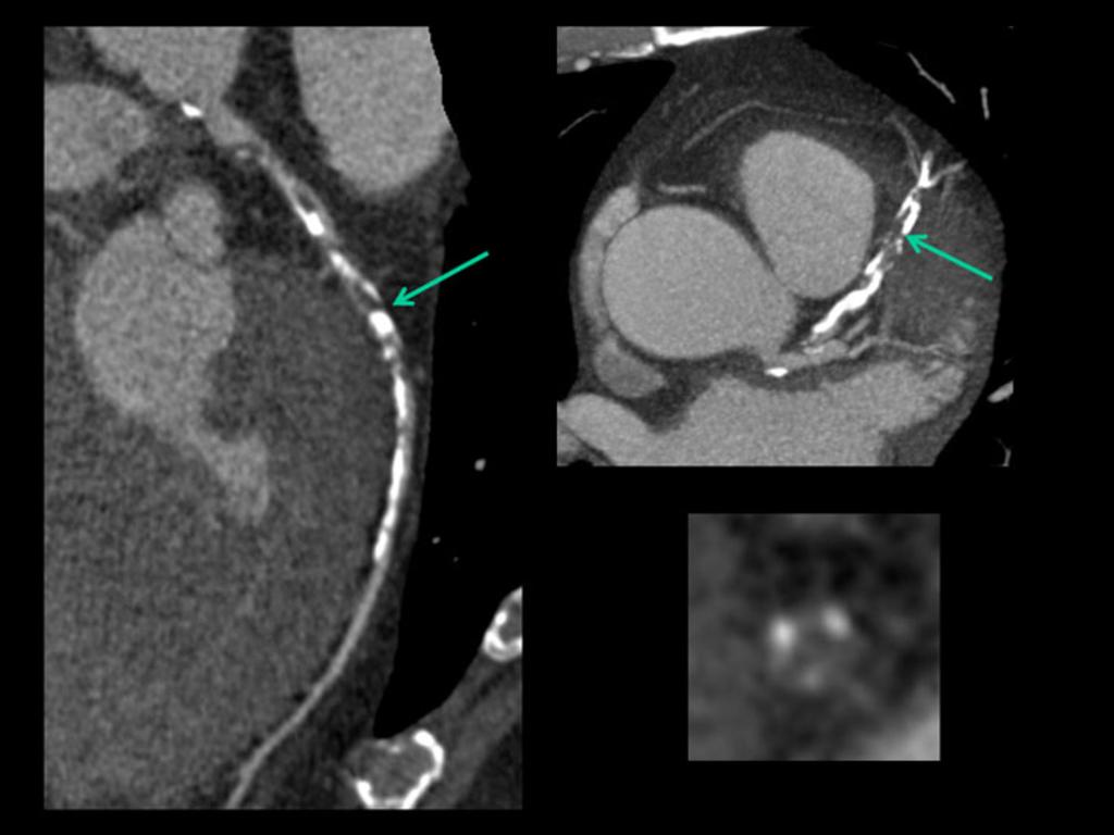 Fig. 11: Moderate coronary stenosis in the proximal segment of the LAD due to a mixed plaque with large calcified component (yellow arrows).
