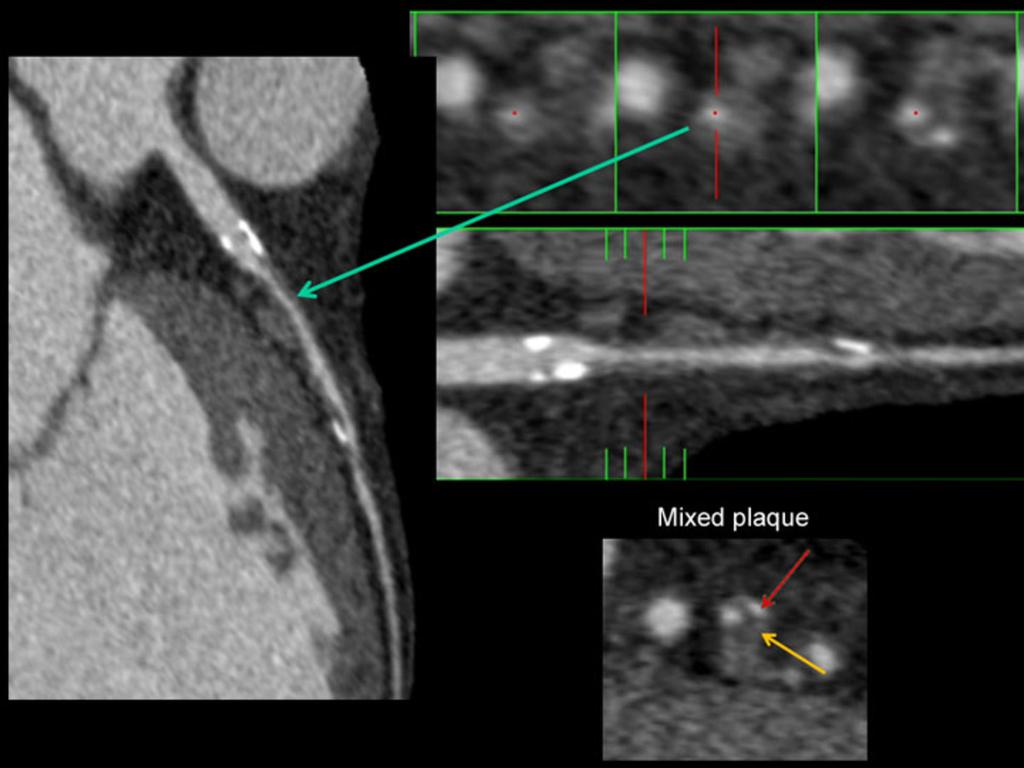 Fig. 13: Large, concentric, predominantly non-calcified plaque in the proximal and middle segments of the LAD artery generating a severe